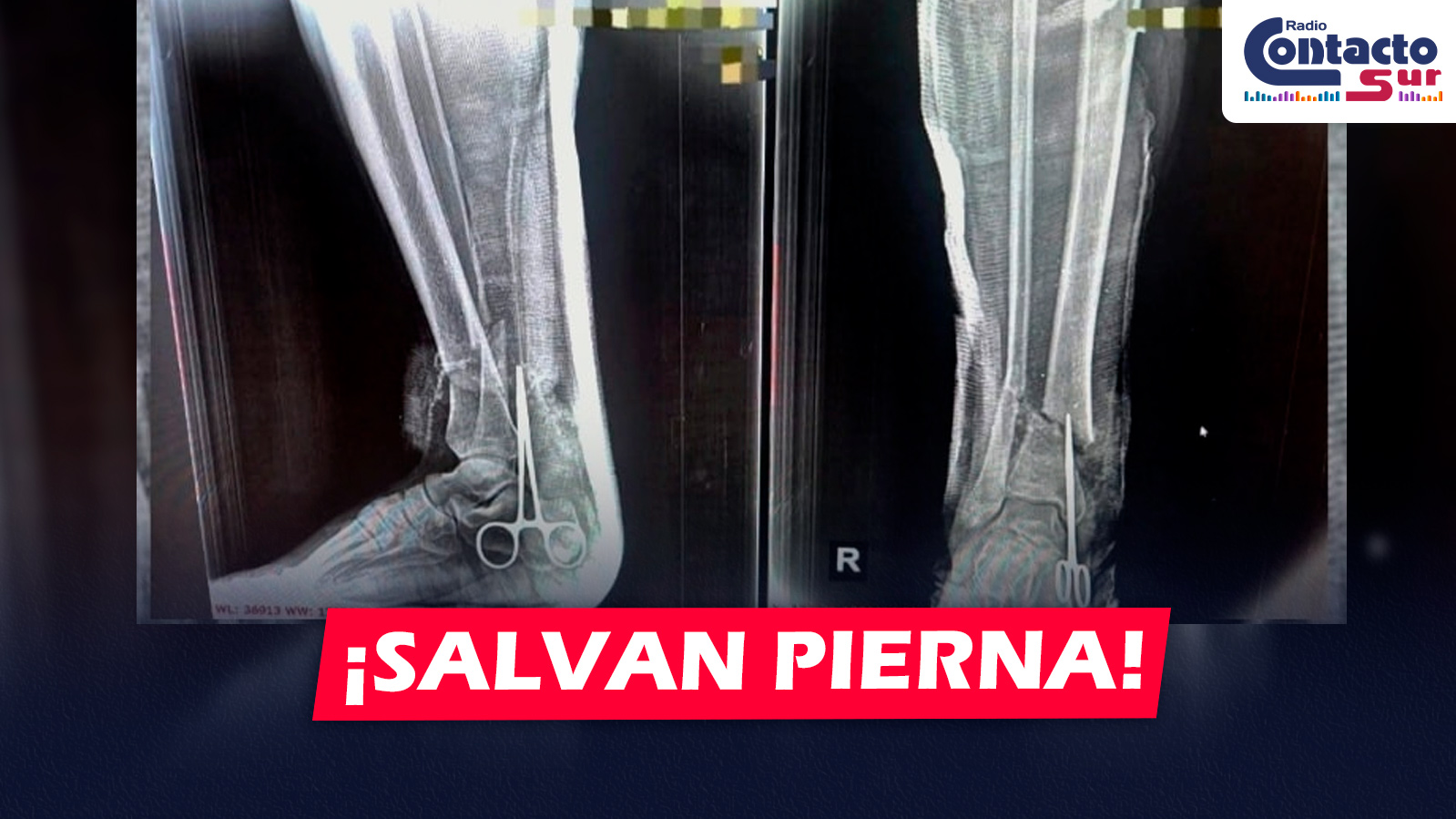 AREQUIPA: HOSPITAL HONORIO DELGADO SALVA PIERNA DE PACIENTE TRAS GRAVE ACCIDENTE CON SIERRA ELÉCTRICA